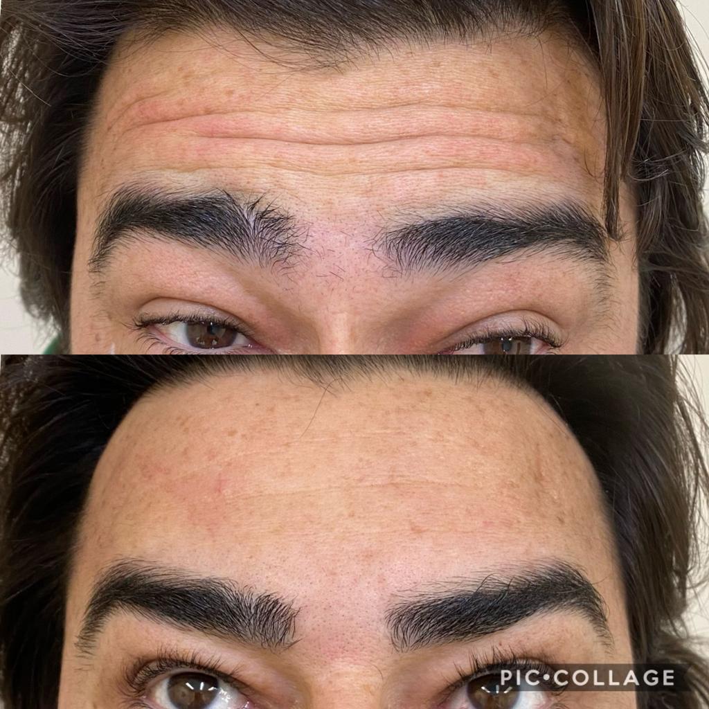 harmonização facial