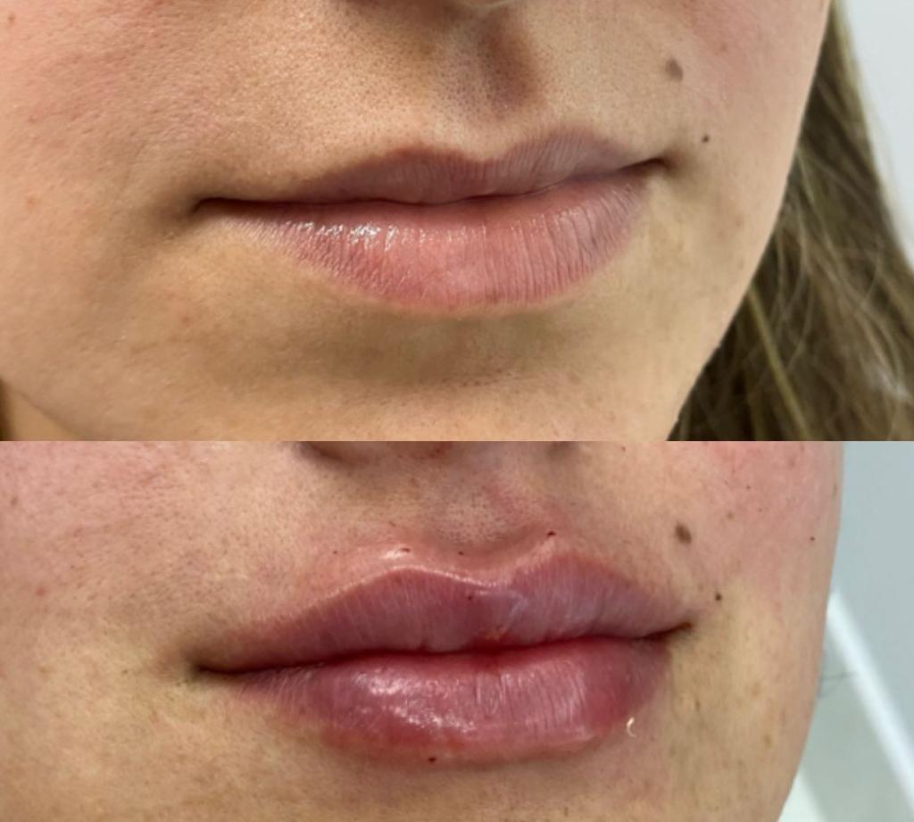 harmonização facial