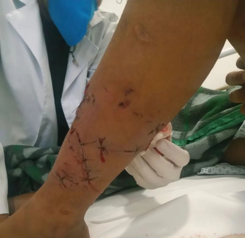 criança de 12 anos é atacado por pitbull em sjc