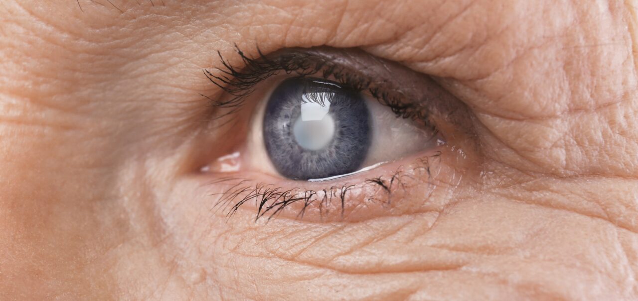 Glaucoma atinge mais de 400 mil pessoas no Estado de SP