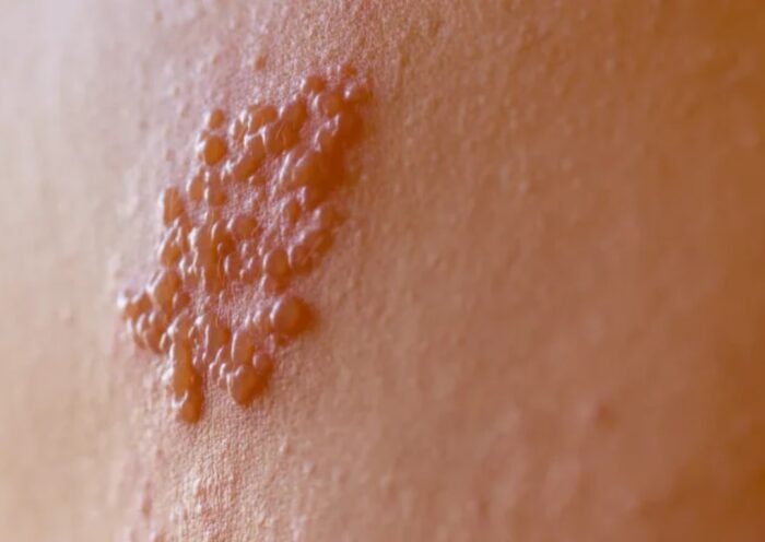 Comissão do Senado aprova vacina contra herpes-zóster no SUS