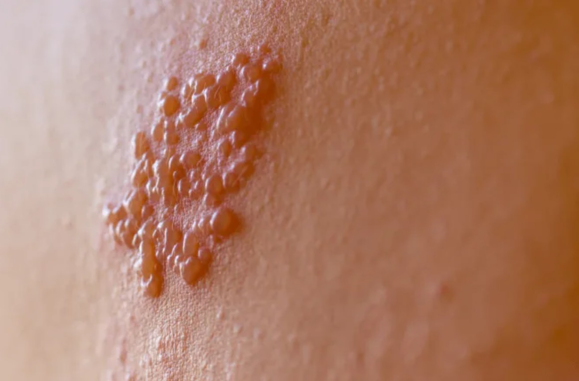Comissão do Senado aprova vacina contra herpes-zóster no SUS